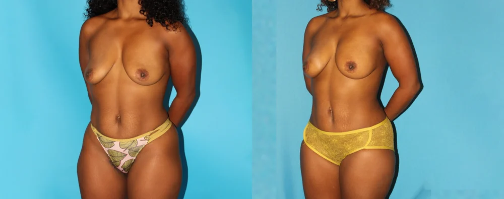 Mommy Makeover case #6509