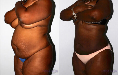 Liposuction case #5834