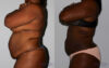 Liposuction case #5834 slider thumbnail
