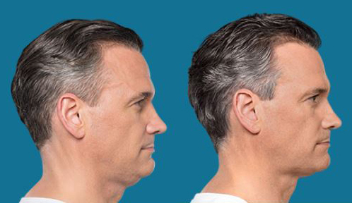 Procedure case #5598