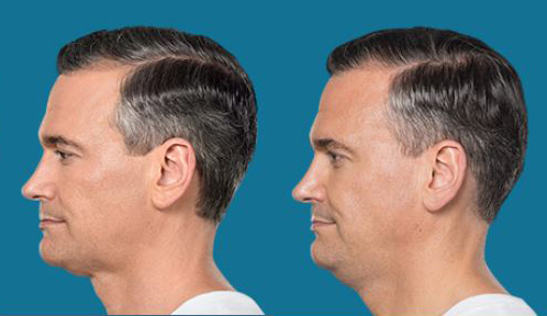 Procedure case #5598