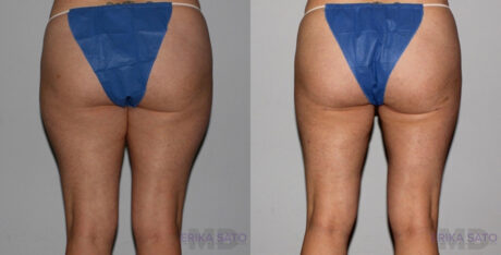 Liposuction case #5832