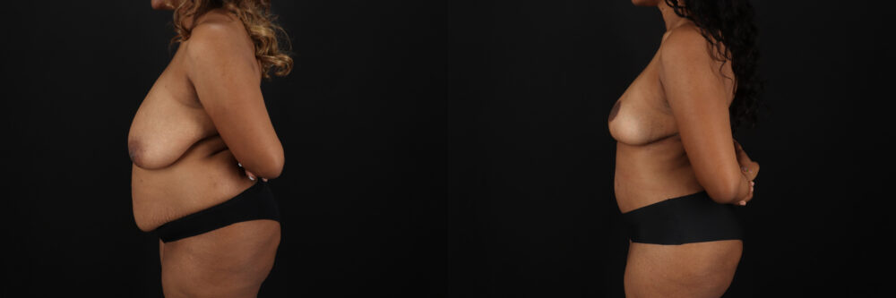 Post Bariatric Surgery (Massive Weight Loss) case #6782