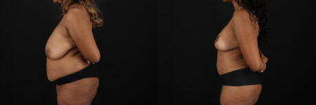 Post Bariatric Surgery (Massive Weight Loss) case #6782