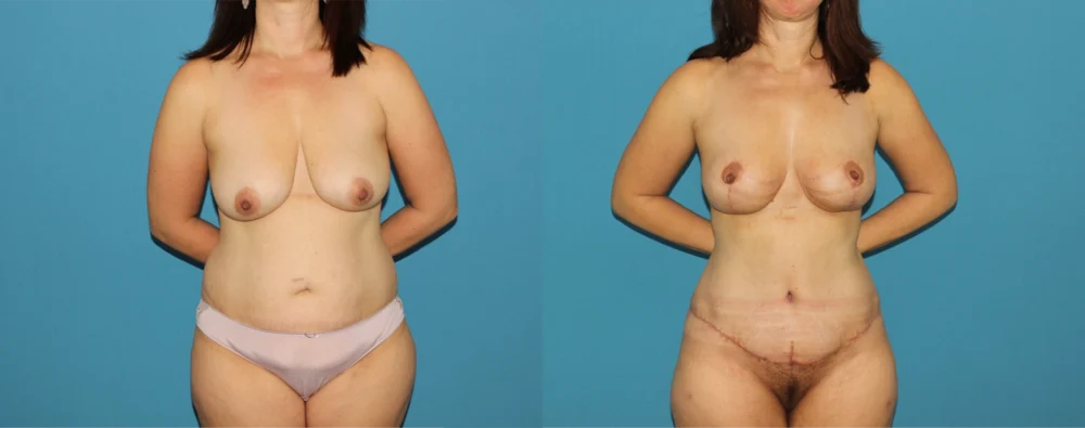 Mommy Makeover case #6510