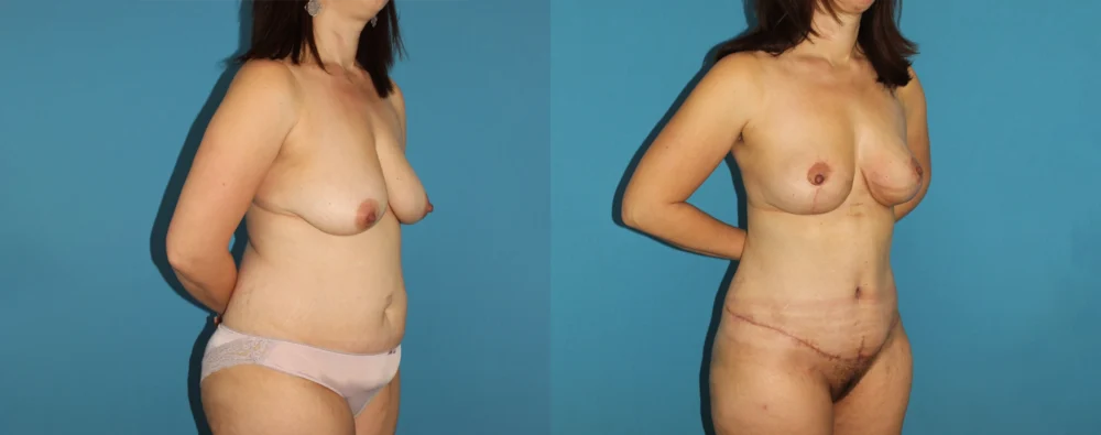 Mommy Makeover case #6510