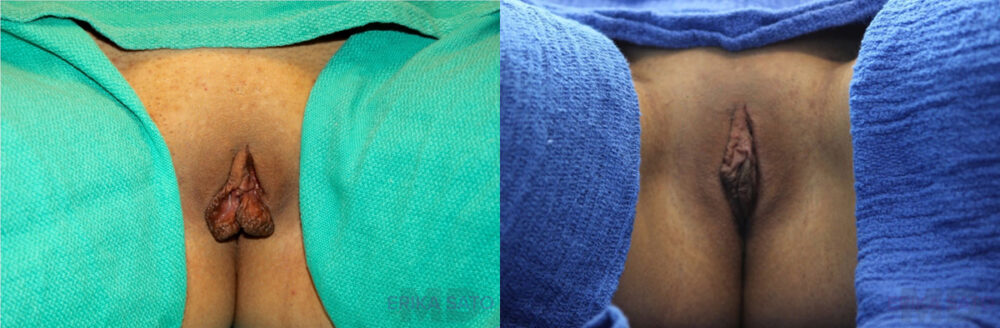 Labiaplasty case #5754