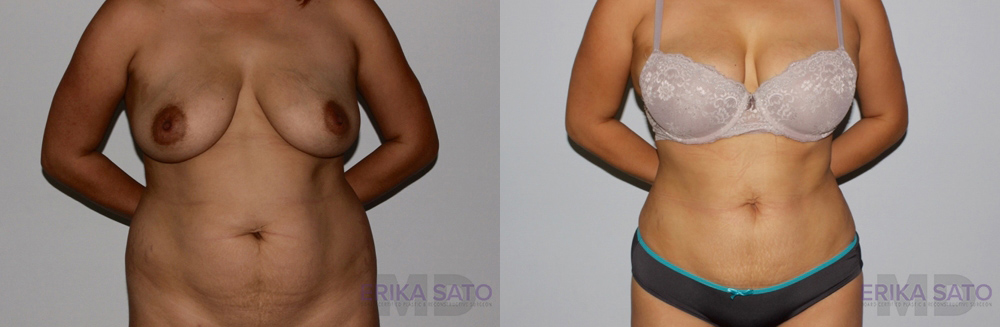 Liposuction case #5830