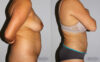 Liposuction case #5830 slider thumbnail