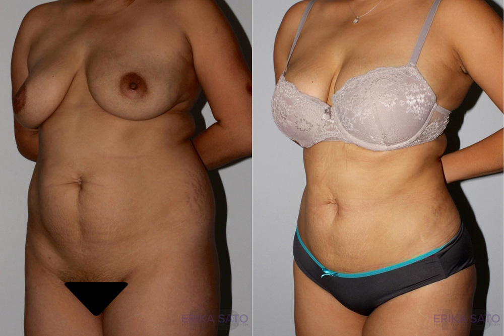Liposuction case #5830
