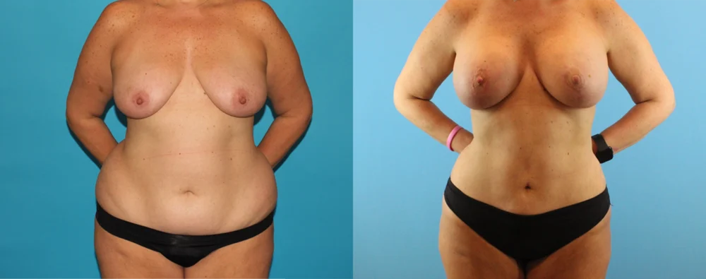 Mommy Makeover case #6511