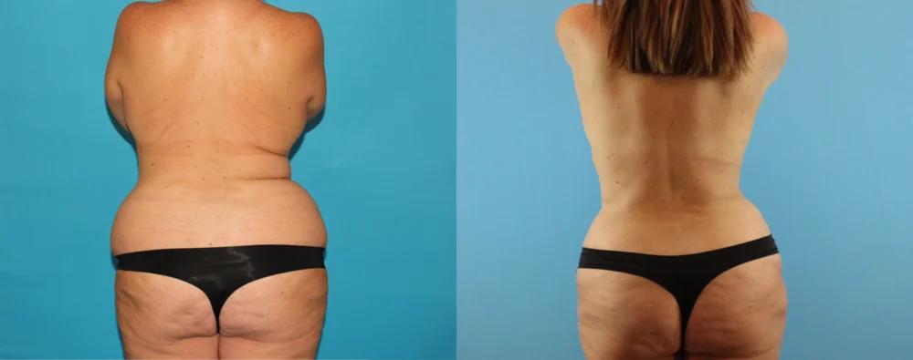 Mommy Makeover case #6511