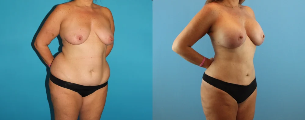 Mommy Makeover case #6511