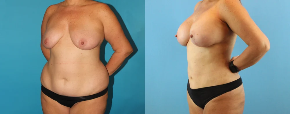 Mommy Makeover case #6511