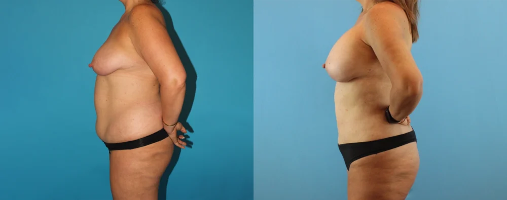 Mommy Makeover case #6511