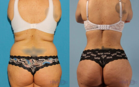 Brazilian Butt Lift case #4821