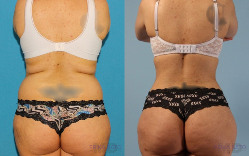 Brazilian Butt Lift case #4821