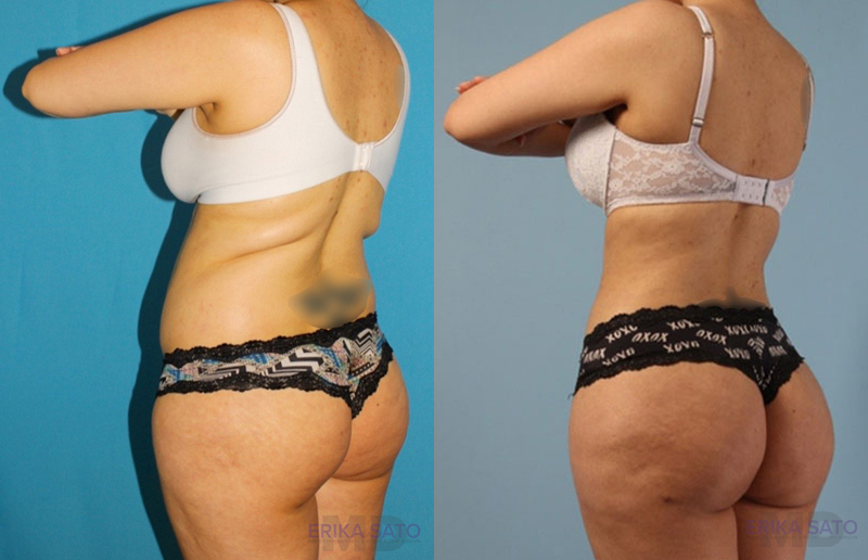 Brazilian Butt Lift case #4821