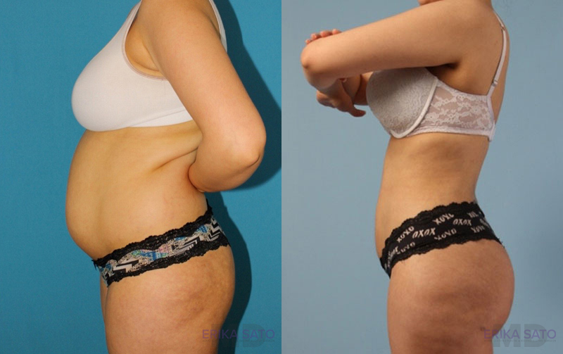 Brazilian Butt Lift case #4821