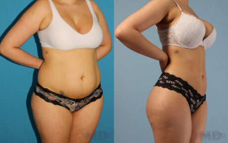 Brazilian Butt Lift case #4821