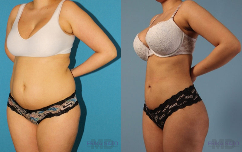 Brazilian Butt Lift case #4821