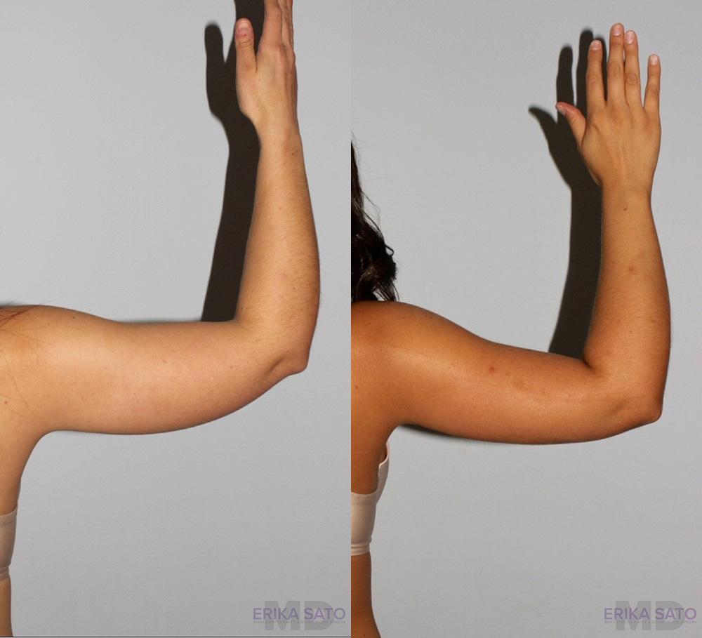 Liposuction case #5827