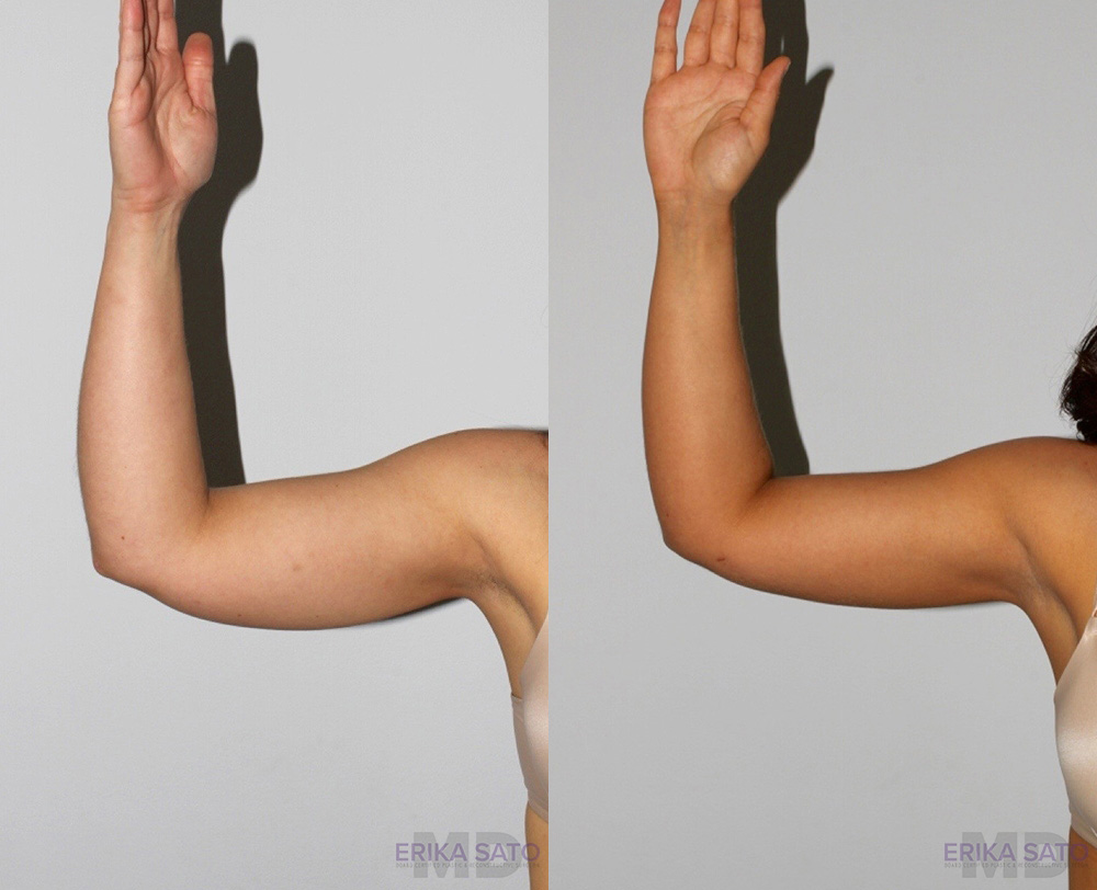 Liposuction case #5827