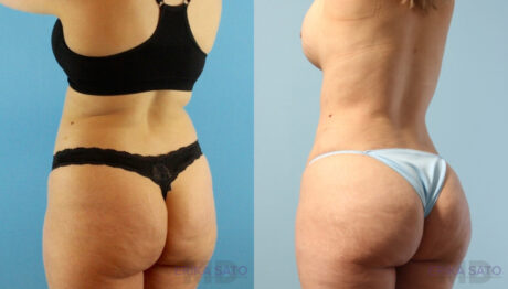 Tummy Tuck case #263490