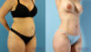 Tummy Tuck case #263490 slider thumbnail