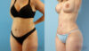 Tummy Tuck case #263490 slider thumbnail