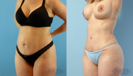 Tummy Tuck case #263490