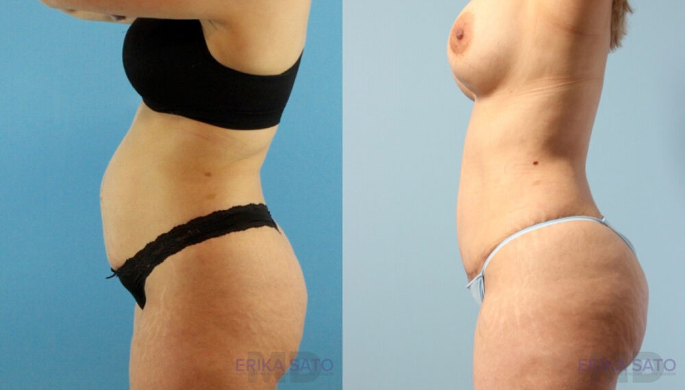 Brazilian Butt Lift case #4882