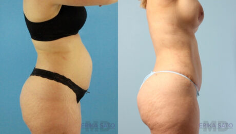 Tummy Tuck case #263490