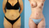 Tummy Tuck case #263490 slider thumbnail