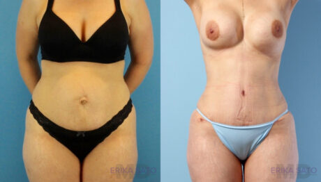 Tummy Tuck case #263490