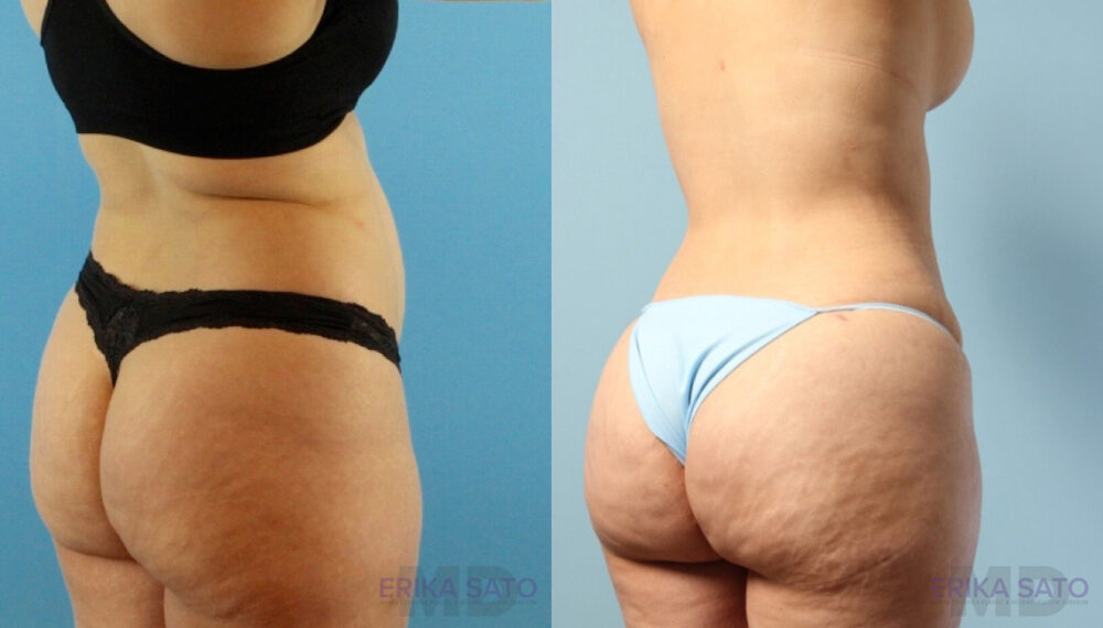 Brazilian Butt Lift case #4882