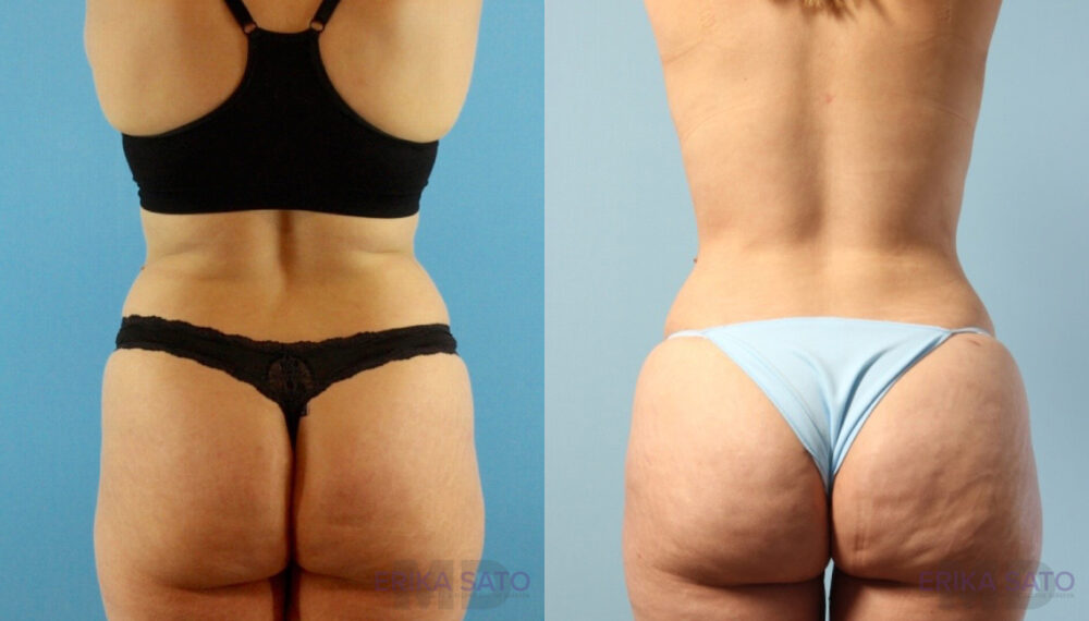 Brazilian Butt Lift case #4882