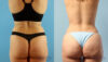 Tummy Tuck case #263490 slider thumbnail