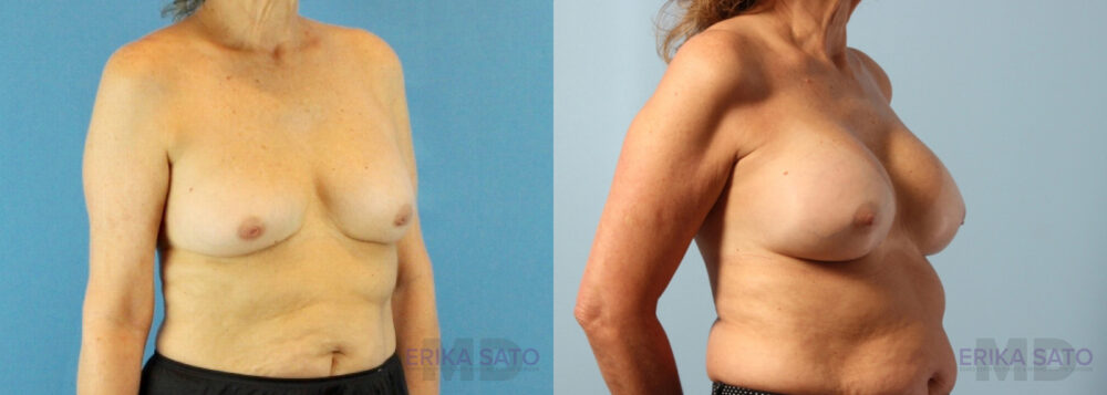 Breast Augmentation case #6297