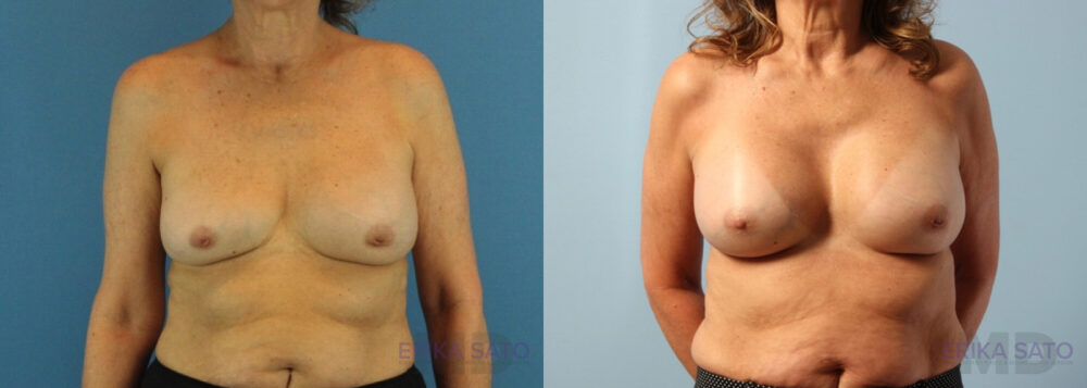 Breast Augmentation case #6297