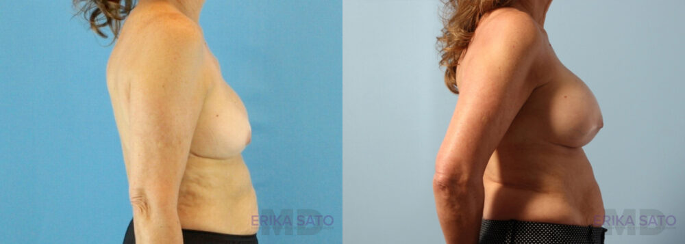 Breast Augmentation case #6297