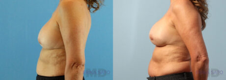 Breast Augmentation case #6297