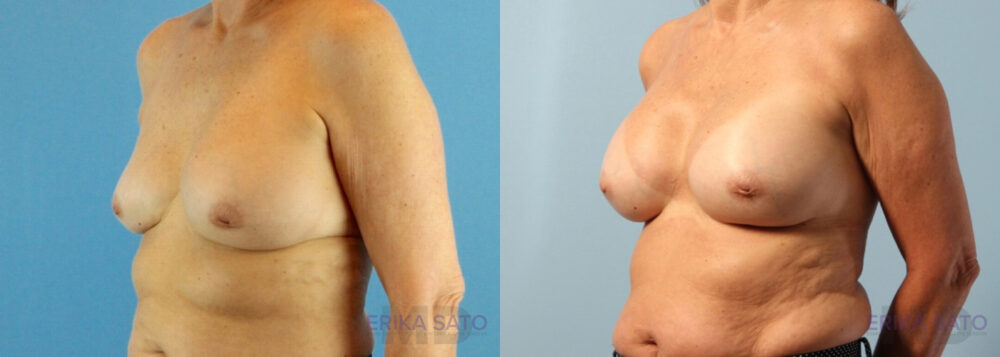 Breast Augmentation case #6297
