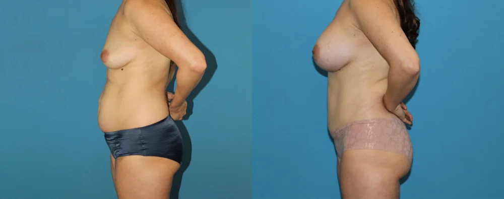 Mommy Makeover case #6512