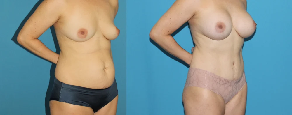 Mommy Makeover case #6512