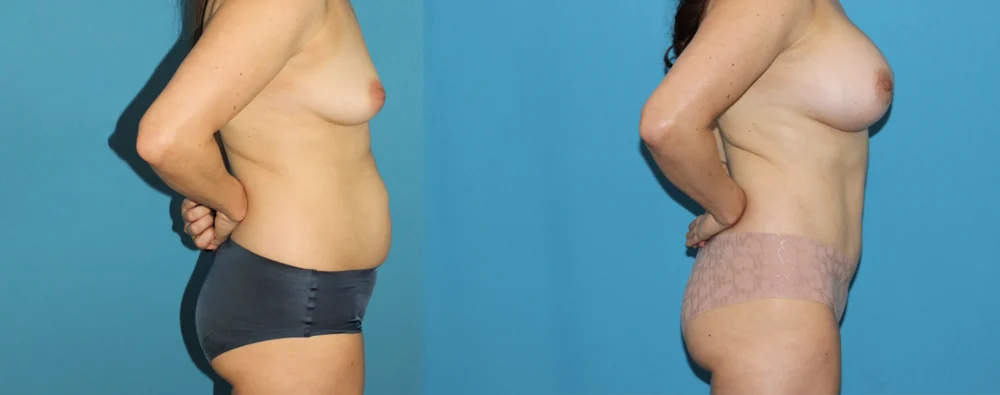 Mommy Makeover case #6512