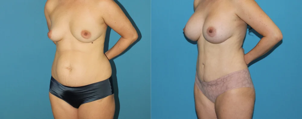 Mommy Makeover case #6512