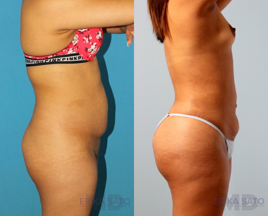 Brazilian Butt Lift case #4823