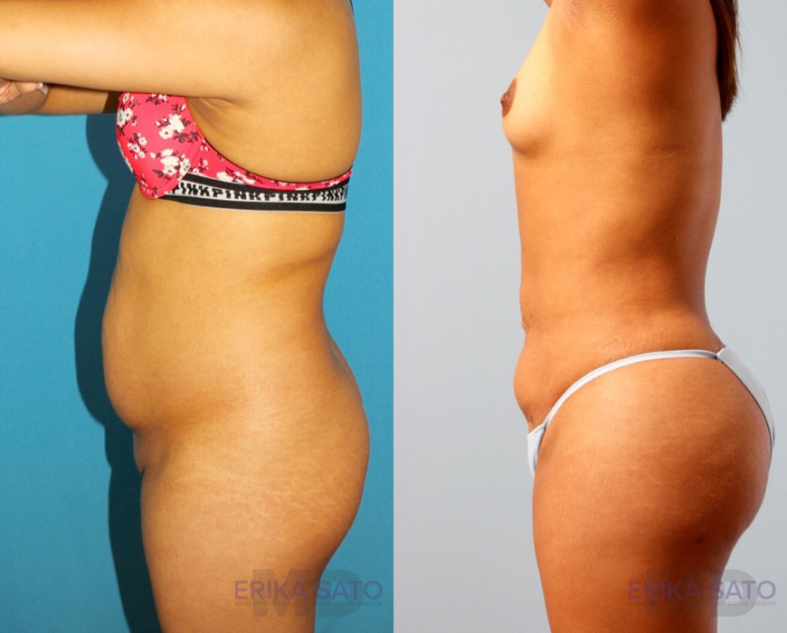 Brazilian Butt Lift case #4823