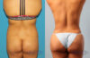 Brazilian Butt Lift case #4823 slider thumbnail